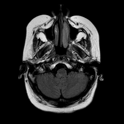 File:Neurofibromatosis type 2 (Radiopaedia 8713-9518 Axial FLAIR 21).jpg