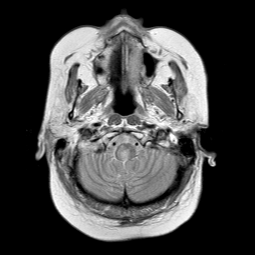 File:Neurofibromatosis type 2 (Radiopaedia 8713-9518 Axial Gradient Echo 22).jpg