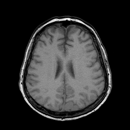 File:Neurofibromatosis type 2 (Radiopaedia 8713-9518 Axial T1 9).jpg