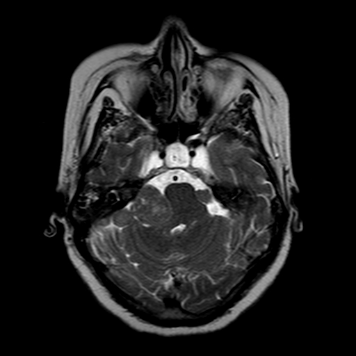 File:Neurofibromatosis type 2 (Radiopaedia 8713-9518 Axial T2 18).jpg