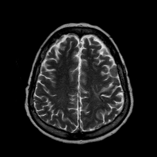 File:Neurofibromatosis type 2 (Radiopaedia 8713-9518 Axial T2 7).jpg