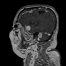 File:Neurofibromatosis type 2 (Radiopaedia 8713-9518 Sagittal T1 C+ 12).jpg