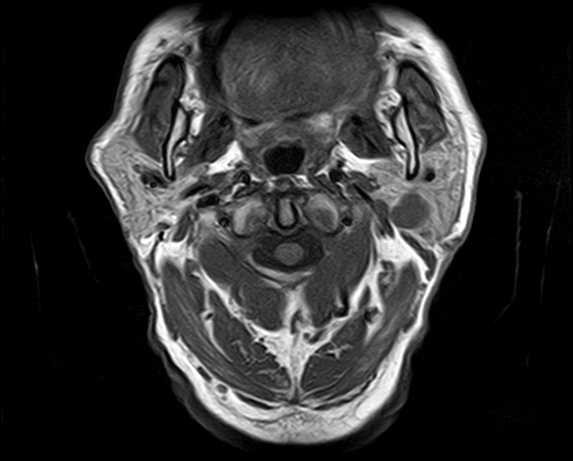 File:Non-Hodgkin lymphoma - parotid gland (Radiopaedia 71531-81890 Axial T1 14).jpg