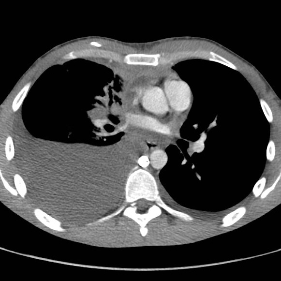 File:Non-Hodgkin lymphoma involving lung (Radiopaedia 29094-29470 B 36).jpg