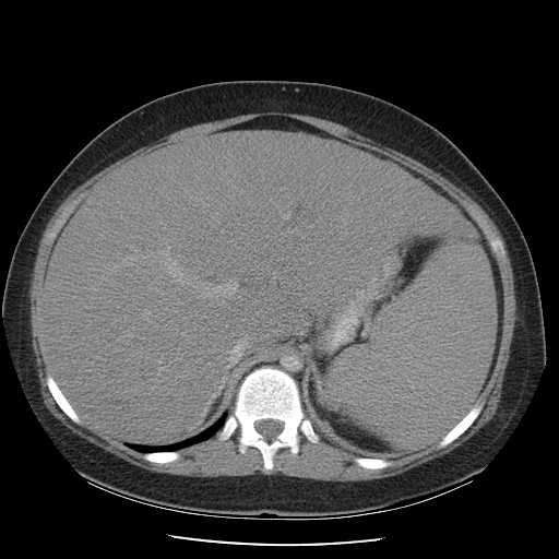 File:Non-Hodgkin lymphoma involving pelvis (Radiopaedia 21281-21197 A 20).jpg