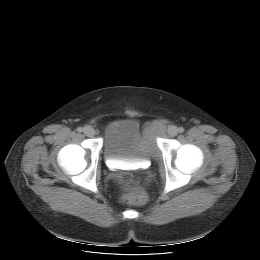 File:Non-Hodgkin lymphoma involving pelvis (Radiopaedia 21281-21197 B 58).jpg
