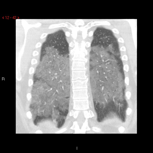 File:Non-specific interstitial pneumonitis (Radiopaedia 27044-27222 Coronal lung window 42).jpg