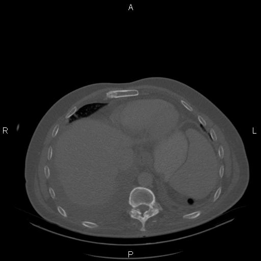 Non Hodgkin lymphoma in a patient with ankylosing spondylitis (Radiopaedia 84323-99624 Axial bone window 24).jpg