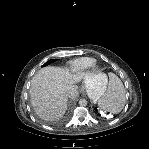 File:Non Hodgkin lymphoma in a patient with ankylosing spondylitis (Radiopaedia 84323-99624 B 25).jpg