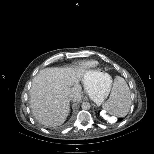 File:Non Hodgkin lymphoma in a patient with ankylosing spondylitis (Radiopaedia 84323-99624 B 26).jpg