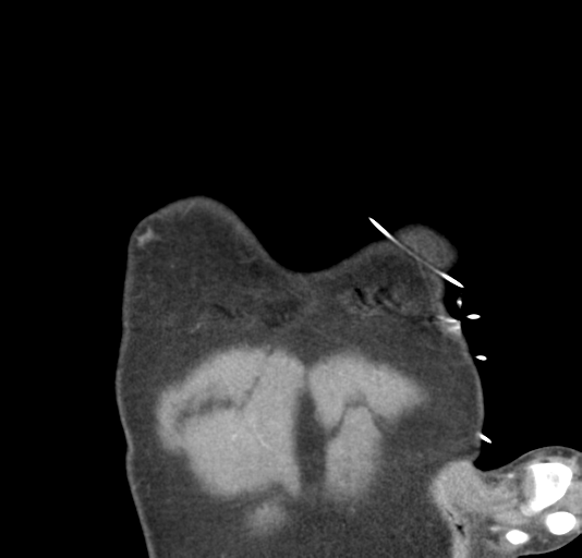 File:Normal CTA thorax (non ECG gated) (Radiopaedia 41750-44704 B 6).png