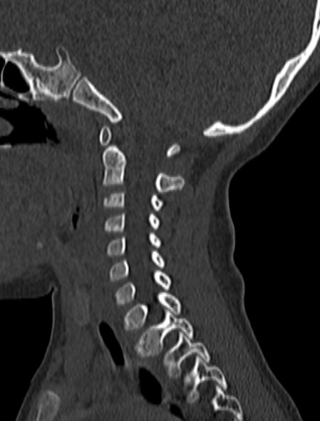 Normal CT cervical spine - pediatric (Radiopaedia 52549-58462 Sagittal bone window 134).jpg