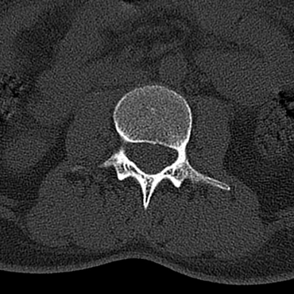File:Normal CT lumbar spine (Radiopaedia 53981-60118 Axial bone window 36).jpg