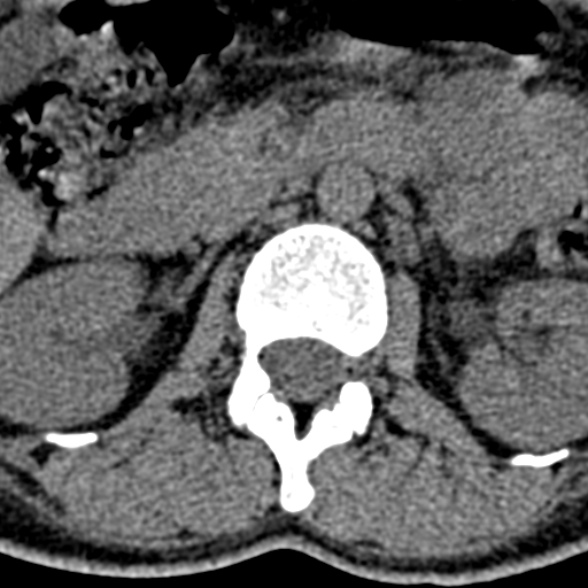 Normal CT lumbar spine (Radiopaedia 53981-60118 Axial non-contrast 27).jpg