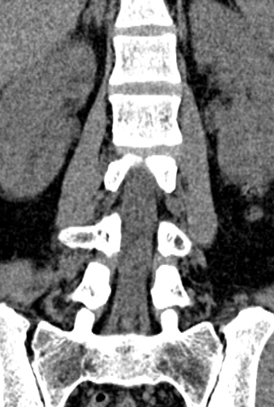 Normal CT lumbar spine (Radiopaedia 53981-60118 F 46).jpg