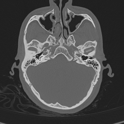 Normal CT skull (Radiopaedia 40798-43459 A 37).png