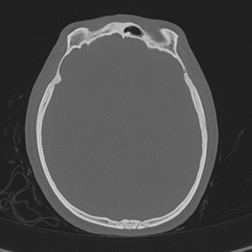 Normal CT skull (Radiopaedia 40798-43459 A 85).png