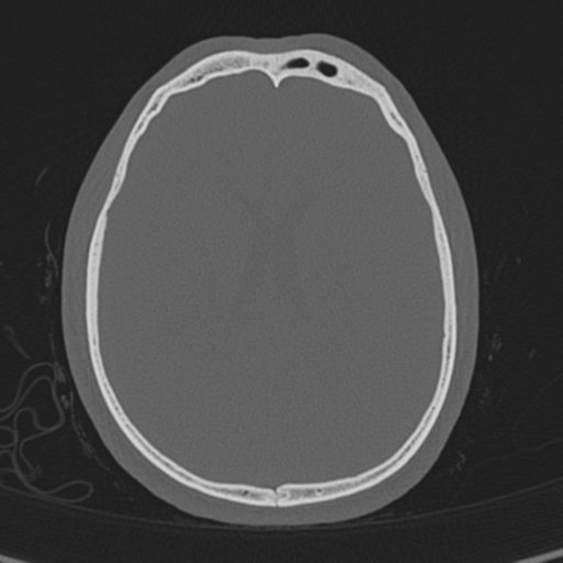 Normal CT skull (Radiopaedia 40798-43459 A 98).png