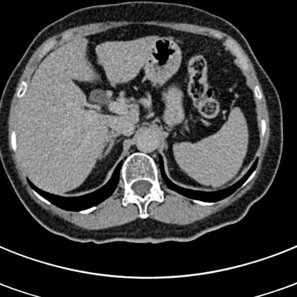 File:Normal CT split bolus study of the renal tract (Radiopaedia 48631-53634 Axial split bolus 12).jpg