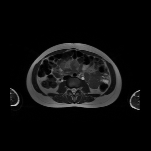 File:Normal MRI abdomen in pregnancy (Radiopaedia 88001-104541 Axial T2 34).jpg
