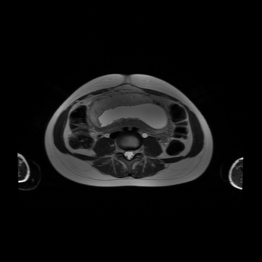 File:Normal MRI abdomen in pregnancy (Radiopaedia 88001-104541 Axial T2 39).jpg