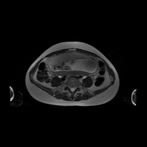 File:Normal MRI abdomen in pregnancy (Radiopaedia 88001-104541 Axial T2 44).jpg