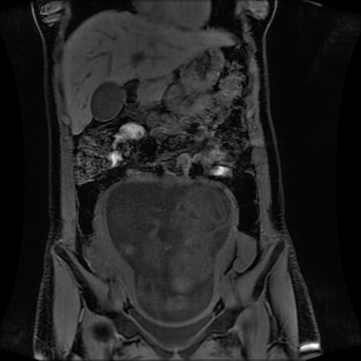 Normal MRI abdomen in pregnancy (Radiopaedia 88001-104541 M 56).jpg