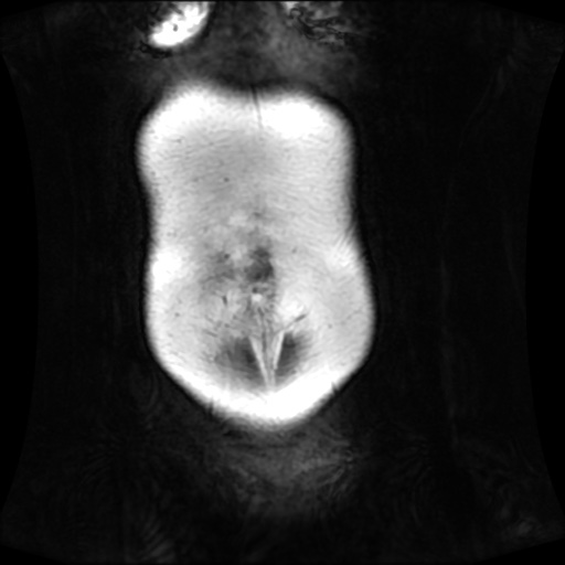 Normal MRI abdomen in pregnancy (Radiopaedia 88001-104541 N 21).jpg