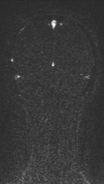 Normal MRI brain with MRV- teenager (Radiopaedia 49425-54553 Coronal MRV 194).jpg