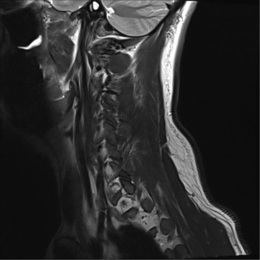 File:Normal MRI cervical spine (infection protocol) (Radiopaedia 53916-60039 Sagittal T2 1).png