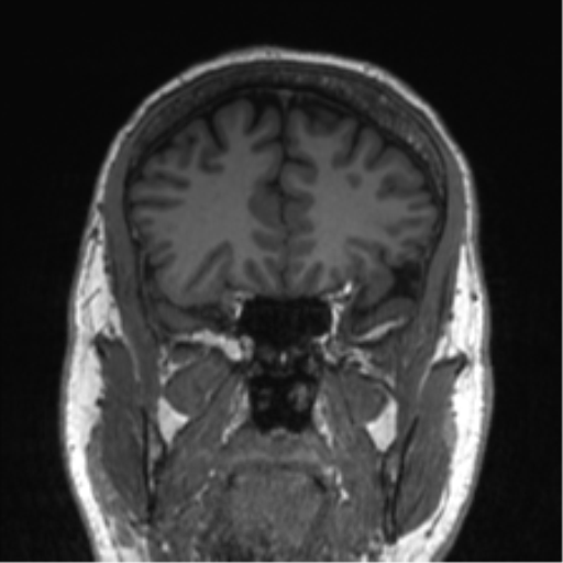 Normal brain MRI (non-focal epilepsy protocol) (Radiopaedia 53917-60040 Coronal T1 49).png