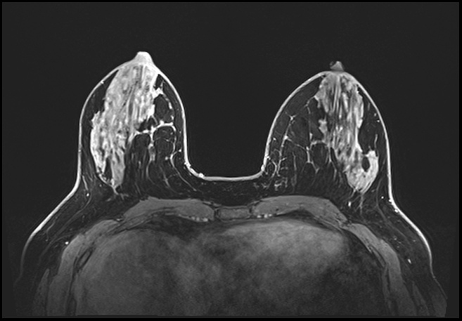 Normal breast MRI - dense breasts (Radiopaedia 80454-93850 C 86).jpg