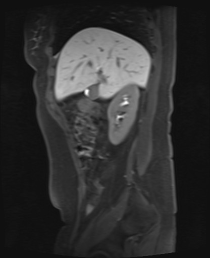 File:Normal hepatobiliary phase liver MRI (Radiopaedia 58968-66230 C 23).jpg