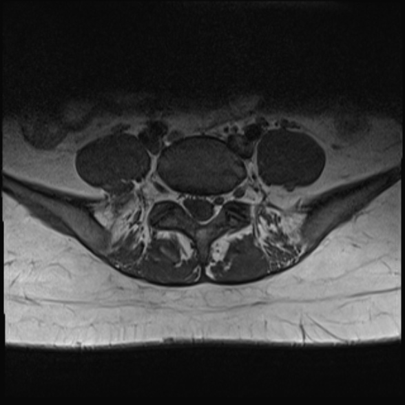 File:Normal lumbar spine MRI- 3 T (Radiopaedia 53280-59250 Axial 26).jpg