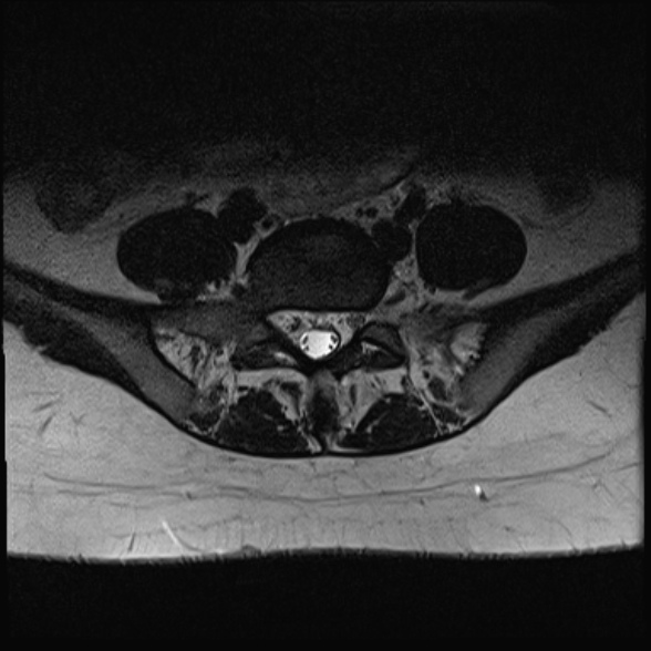File:Normal lumbar spine MRI- 3 T (Radiopaedia 53280-59250 Axial T2 28).jpg