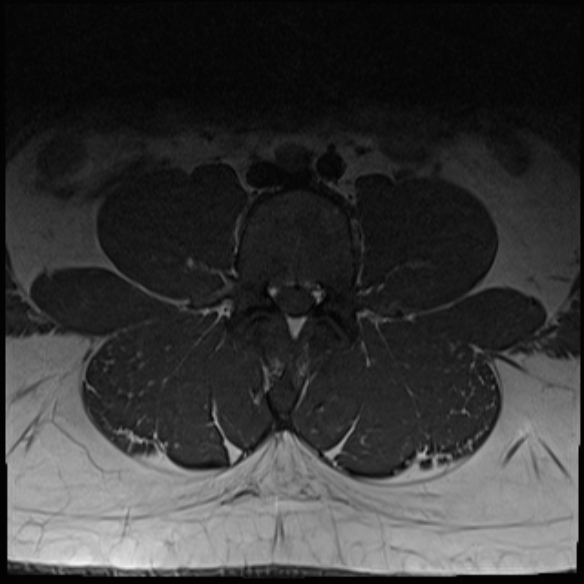 File:Normal lumbar spine MRI (Radiopaedia 47857-52609 Axial T1 11).jpg
