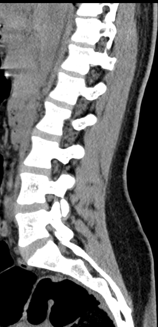 Normal lumbosacral CT (Radiopaedia 37923-39867 E 67).png