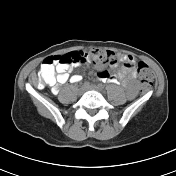 File:Normal multiphase CT liver (Radiopaedia 38026-39996 Axial non-contrast 56).jpg