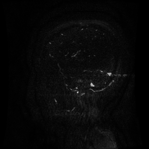 Normal noncontrast MR venography (Radiopaedia 87578-103957 A 32).jpg