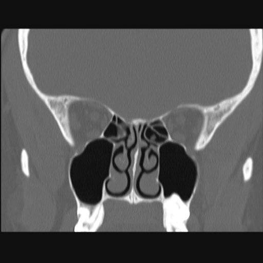 Normal sinus CT (annotated) (Radiopaedia 78917-91810 Coronal bone window 33).jpg