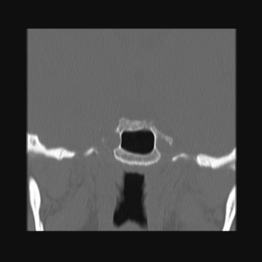 Normal sinus CT (annotated) (Radiopaedia 78917-91810 Coronal bone window 51).jpg
