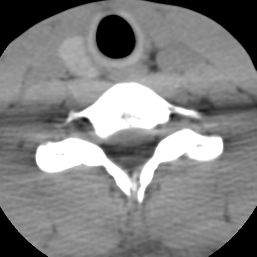 Normal trauma cervical spine (Radiopaedia 41017-43760 Axial non-contrast 47).png