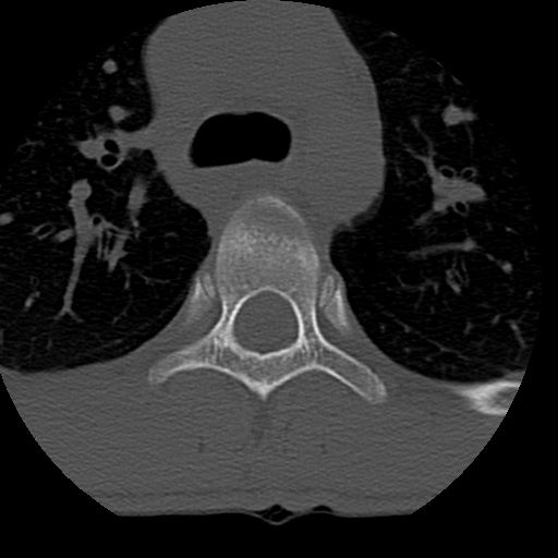 Normal trauma spine imaging (age 16) (Radiopaedia 45335-49358 Axial bone window 110).jpg