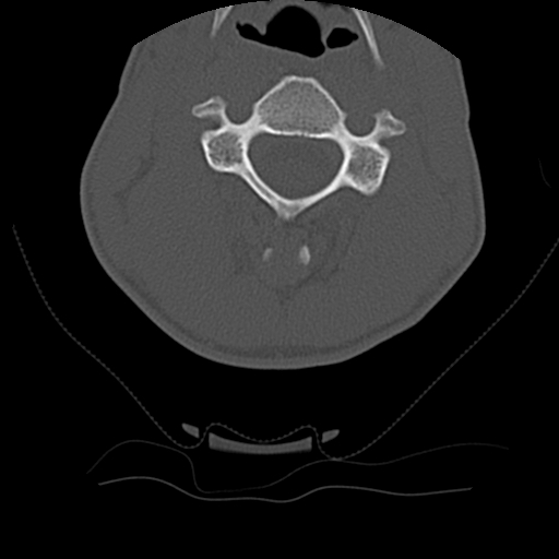 Normal trauma spine imaging (age 16) (Radiopaedia 45335-49358 Axial bone window 30).jpg