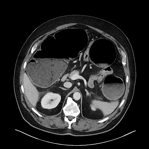 Obstructing sigmoid adenocarcinoma (Radiopaedia 58465-65619 A 52).jpg