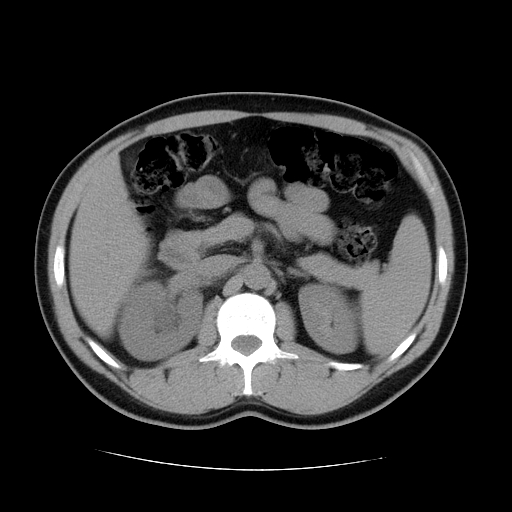 File:Obstructing ureteric calculus (Radiopaedia 18615-18514 Axial non-contrast 20).jpg