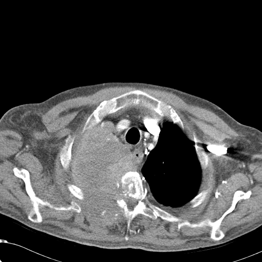 File:Obstructive superior vena cava tumor thrombus (Radiopaedia 28046-28306 A 9).jpg