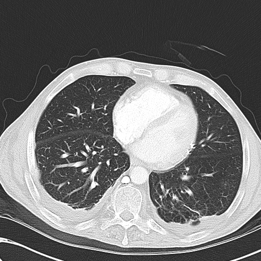 File:Obstructive superior vena cava tumor thrombus (Radiopaedia 28046-28306 Axial lung window 37).jpg