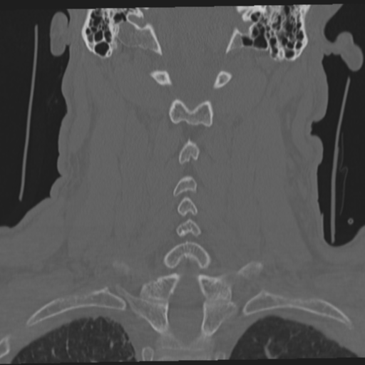 File:Occipital condyle fracture (Radiopaedia 33467-34517 Coronal bone window 43).png