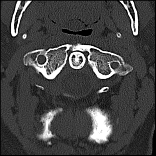 Occipital condyle fracture (type 1) (Radiopaedia 87670-104084 Axial bone window 18).jpg